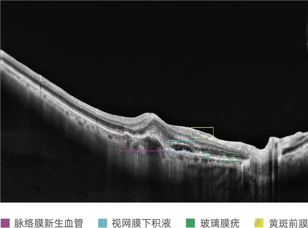 医学院陈新建教授团队获得全球首张医用OCT AI三类证