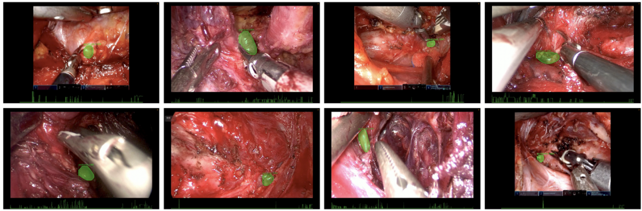 医学院李超教授团队在欧洲外科肿瘤学杂志（EJSO）发表医工结合新成果
